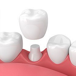 Dental crowns in San Francisco, CA