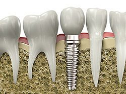 Dental implants in San Francisco, CA